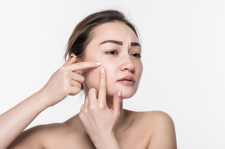 Acne Treatment in Navi Mumbai