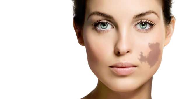 Birthmark Removal in Navi Mumbai