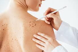 Mole Removal Treatment Navi Mumbai