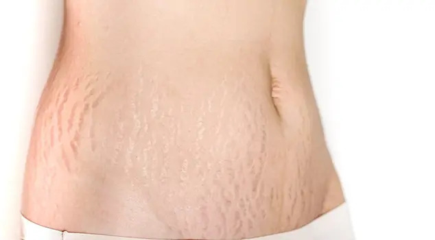 Stretch Mark Treatment in Navi Mumbai 