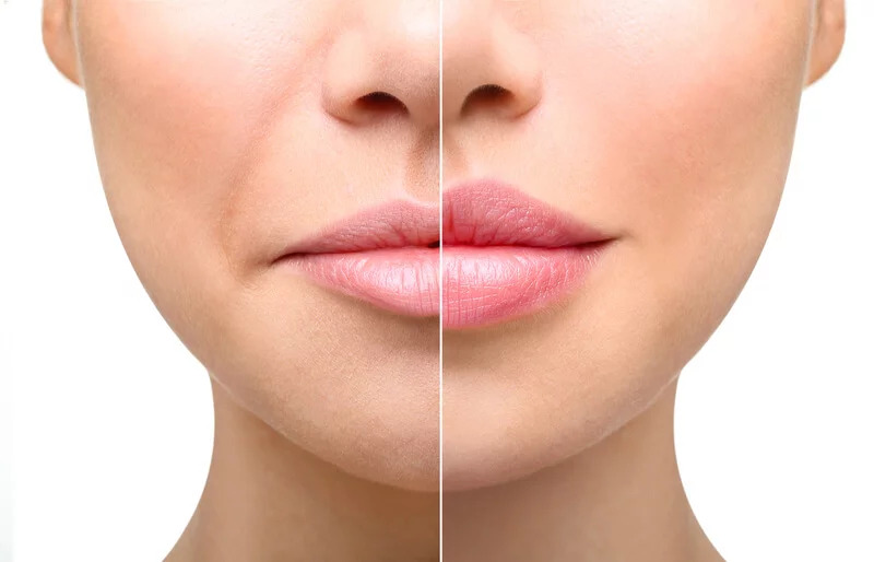 Lip Augmentation Surgery in Navi Mumbai